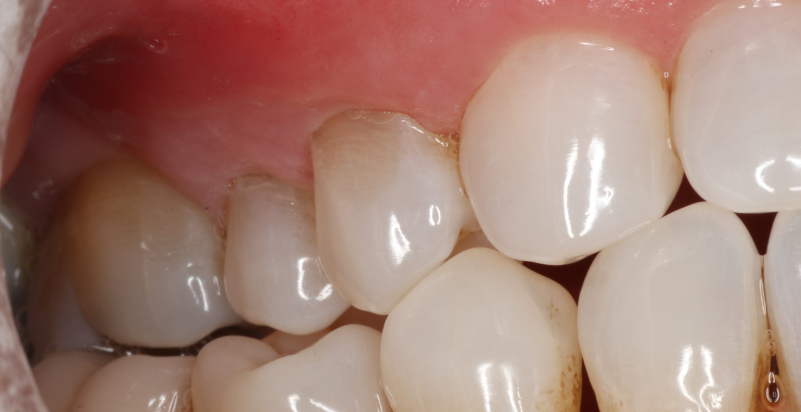 Chao Pinhole gum rejuvenation , DC Pearls patient result
