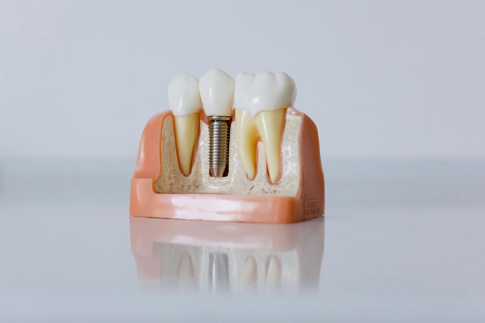 Full-arch dental implants at DC Pearls