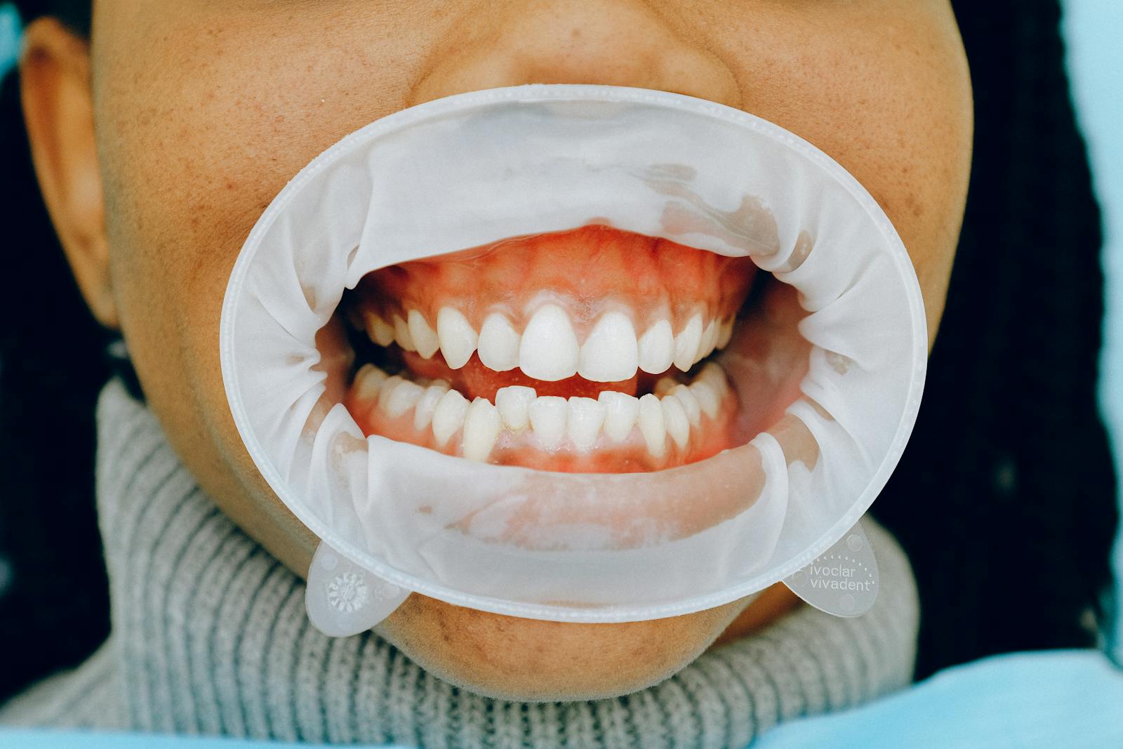 Gum contouring procedure at DC Pearls