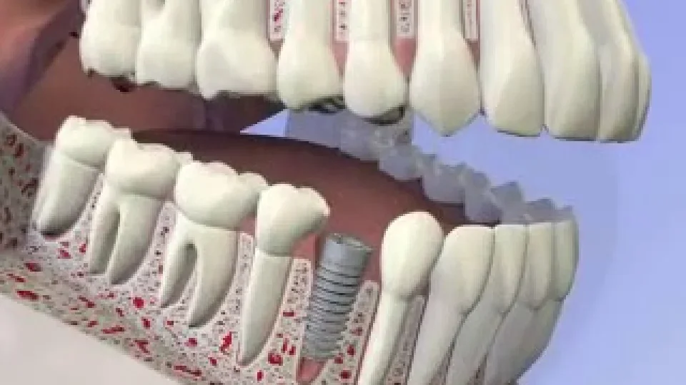 Dental implants , DC Pearls