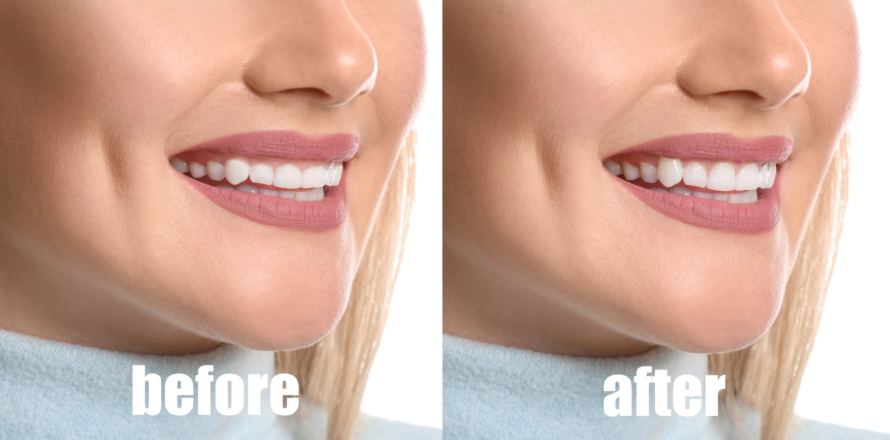 Gum tissue treatment at DC Pearls Dental Boutique