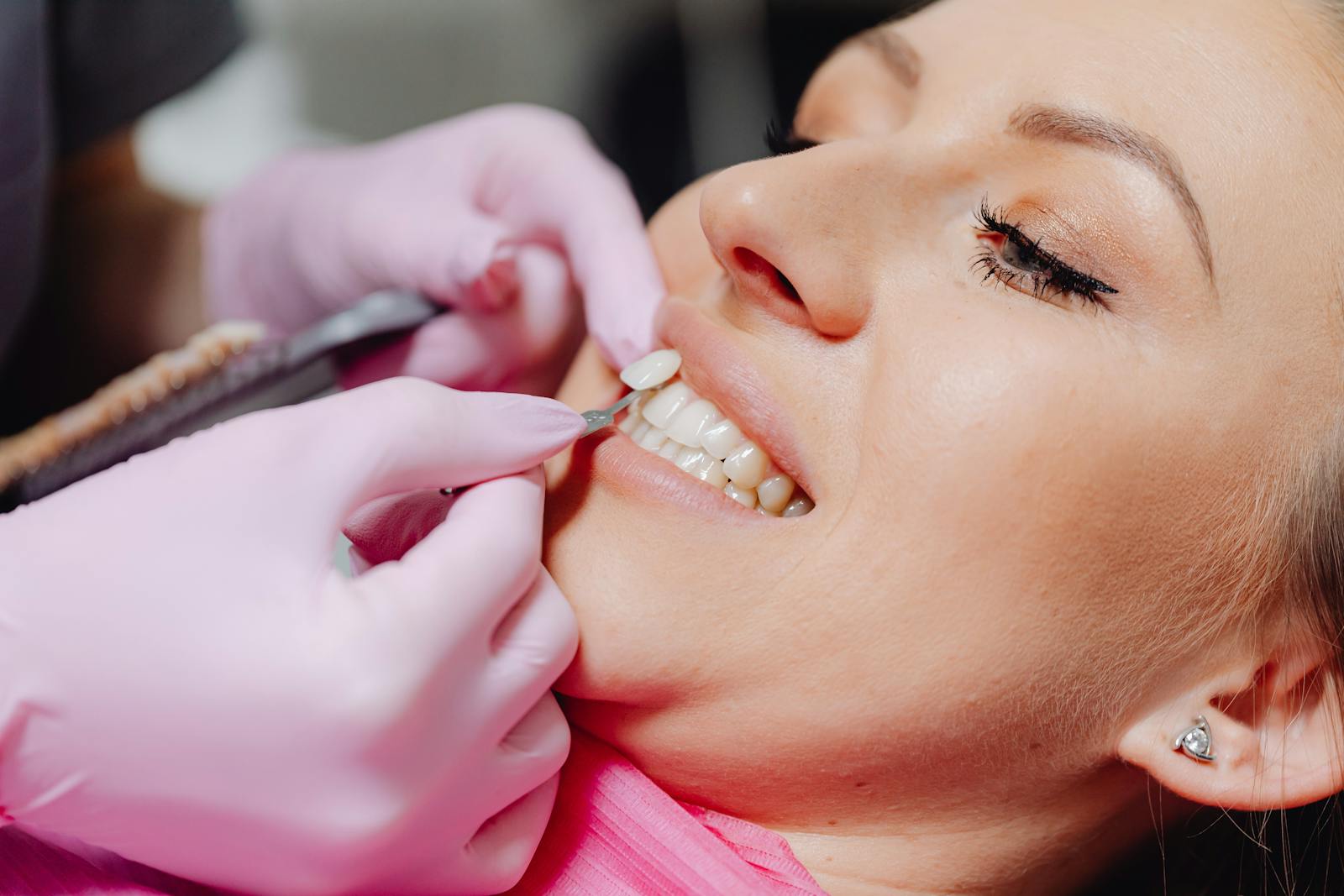 Porcelain veneer application on patient at DC Pearls