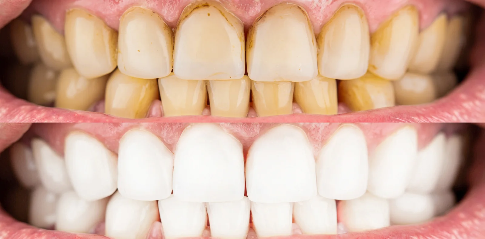 Zoom Advanced Professional Whitening at DC Pearls Dental Boutique