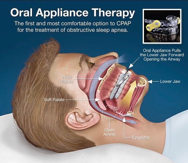 Oral appliance therapy diagram showing how the device opens the airway
