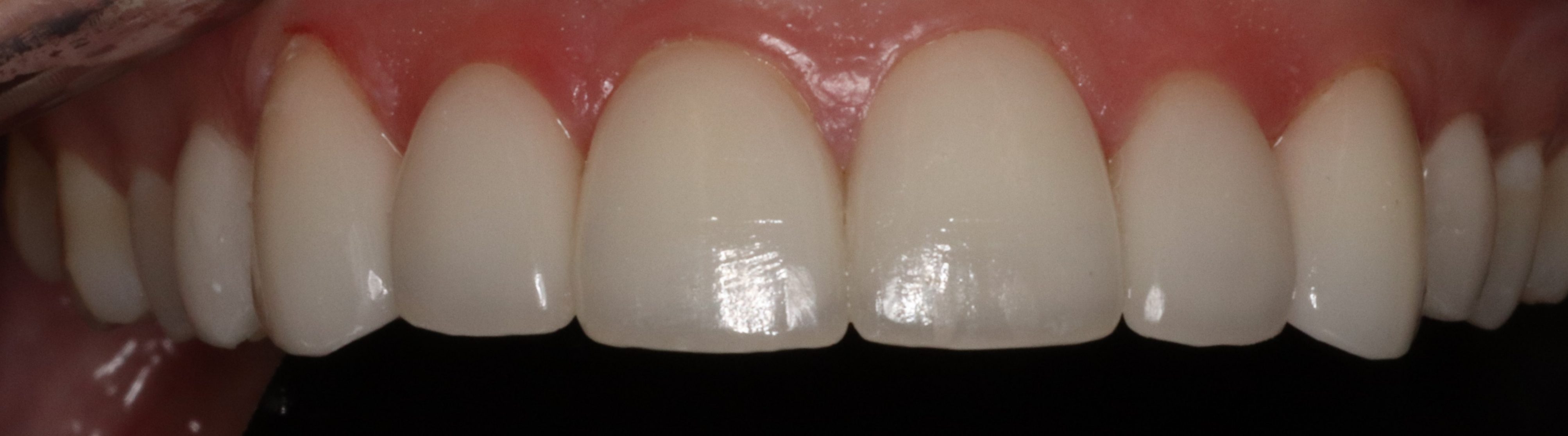 Jasmine after veneers
