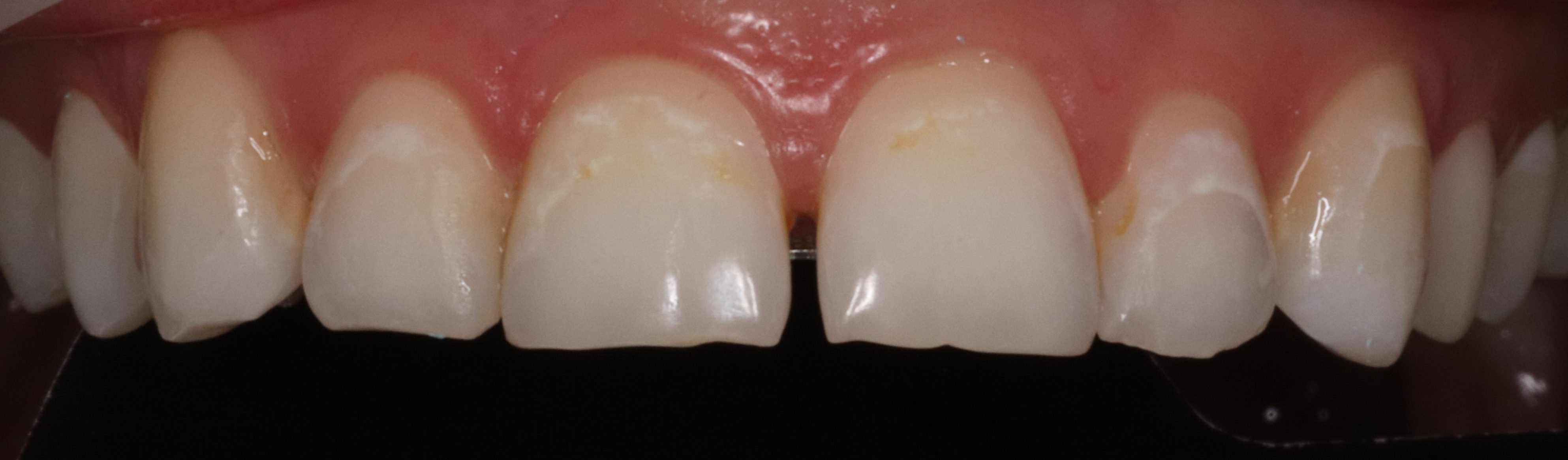 Jasmine before veneers
