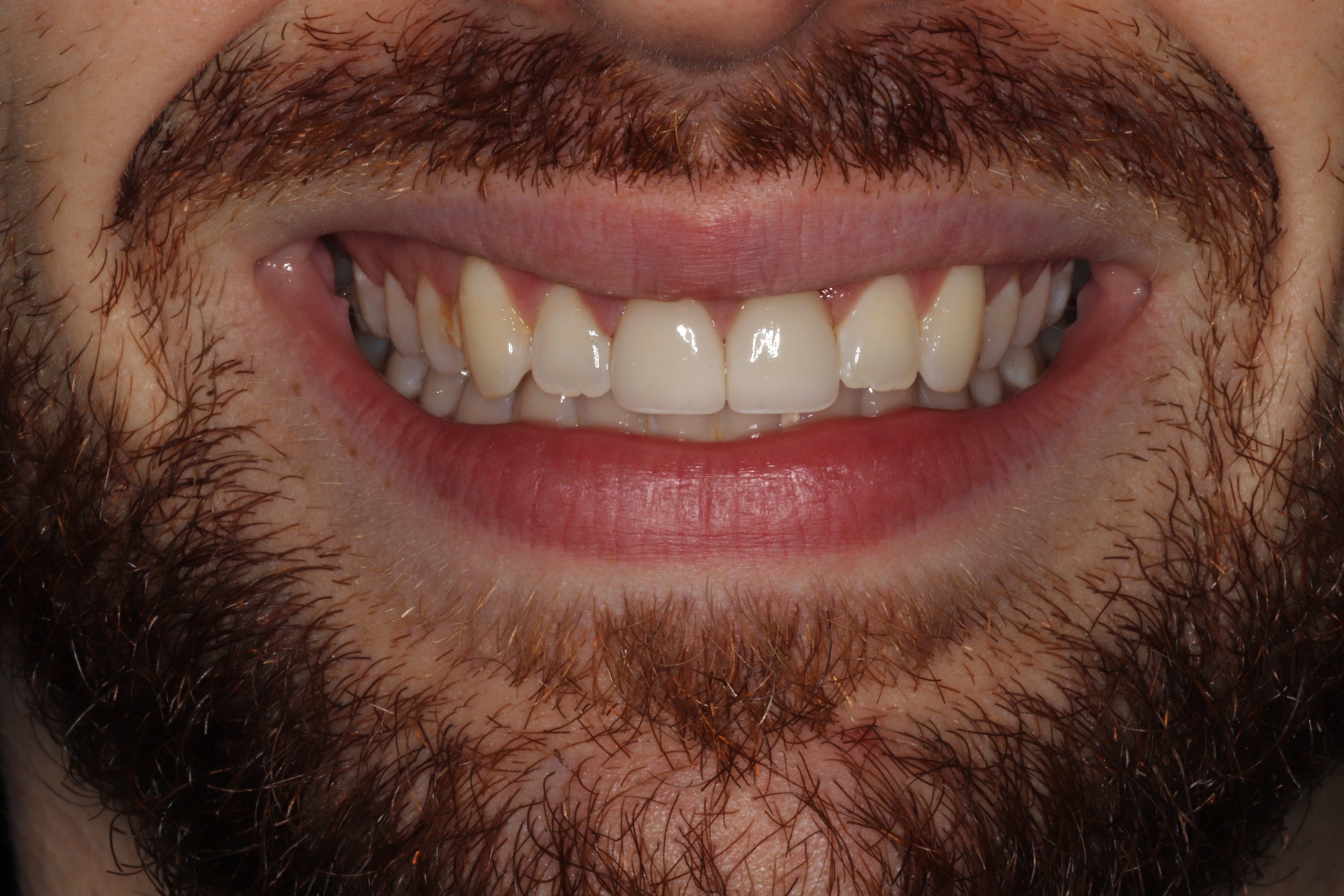 Dental implants , DC Pearls