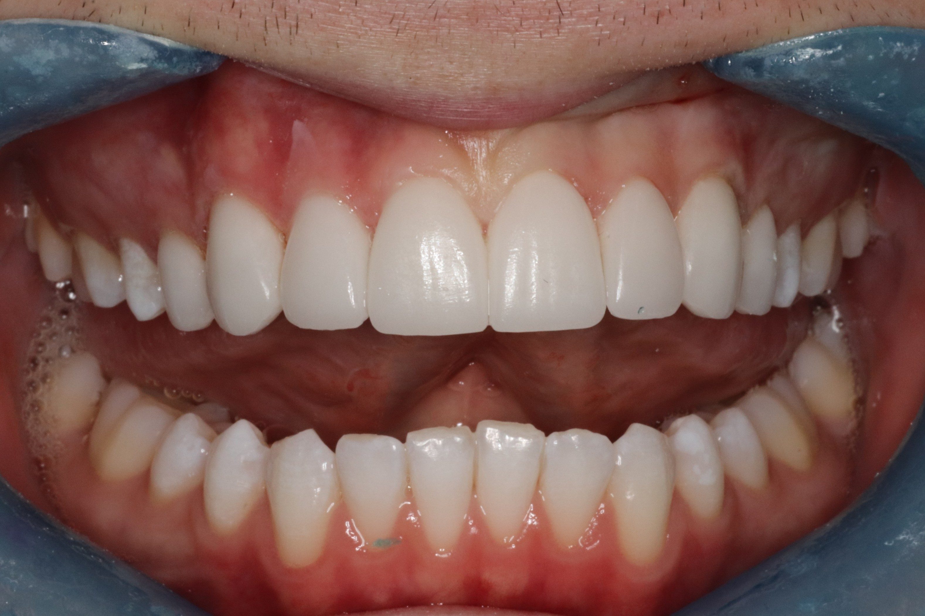 Porcelain veneers , DC Pearls patient result