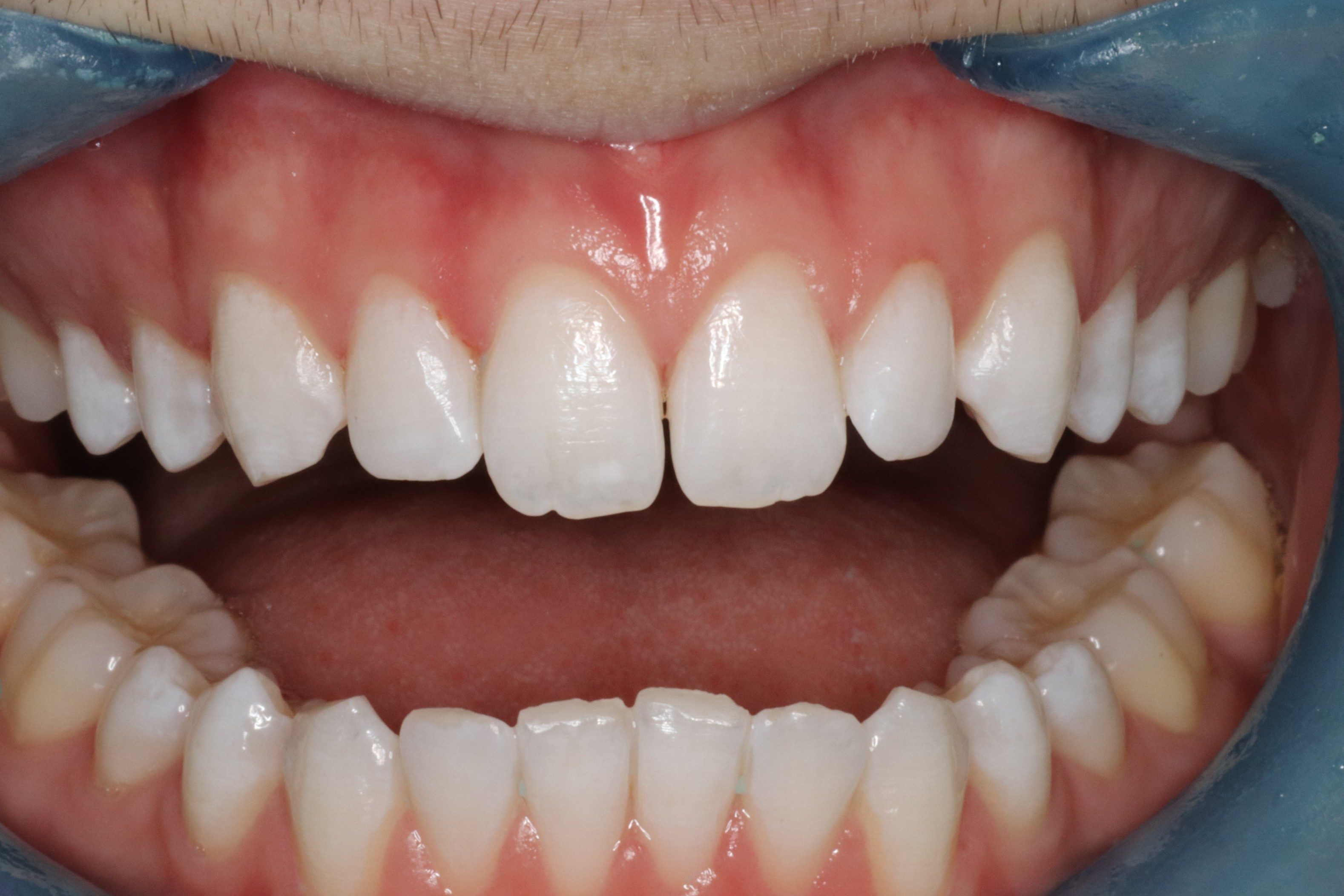 Lauren before veneers