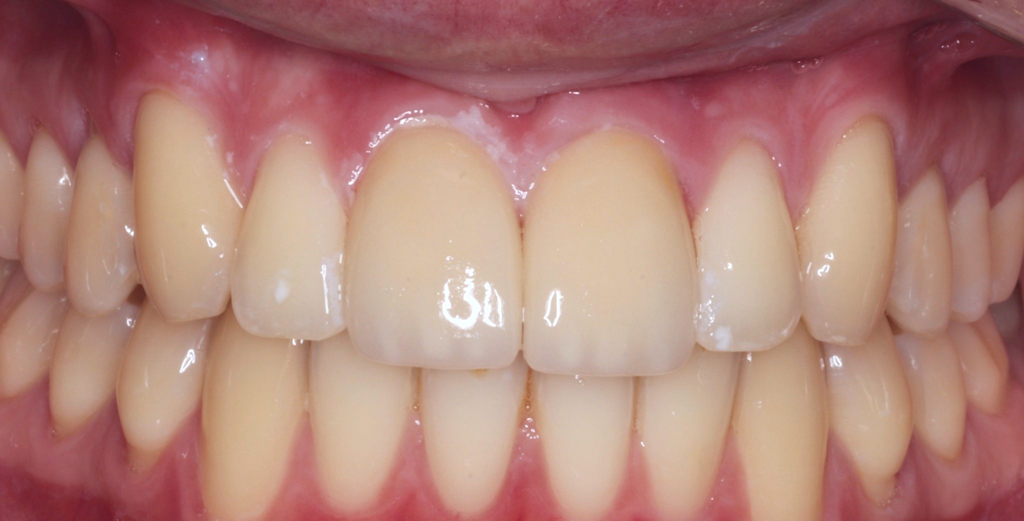 Nana after veneers