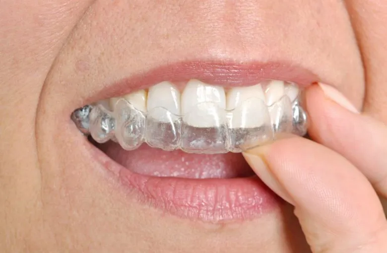invisalign can be a discreet alternative to traditional metal braces