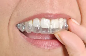 Person putting on clear braces
