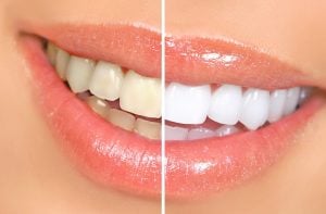 Tooth whitening example