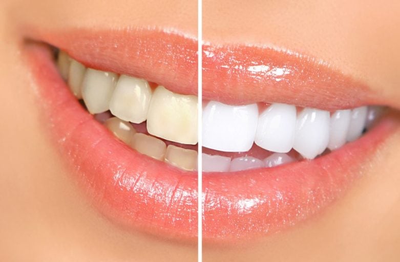 tooth whitening can help brighten your smile