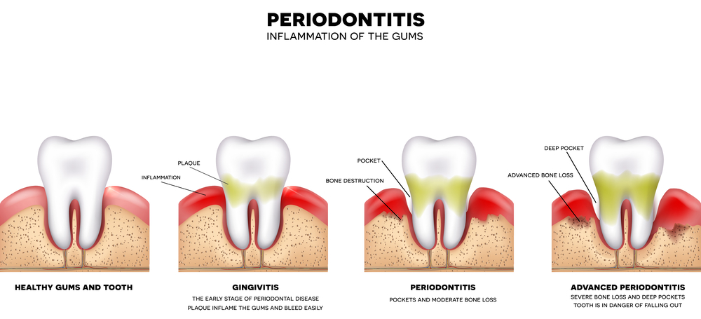 Periodontal disease illustration