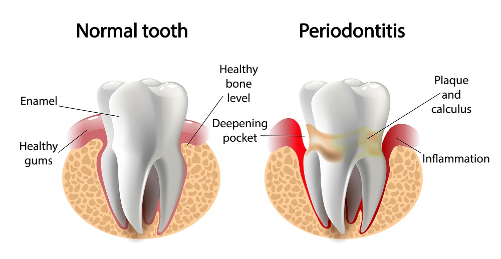 Illustration of a normal tooth vs periodontis