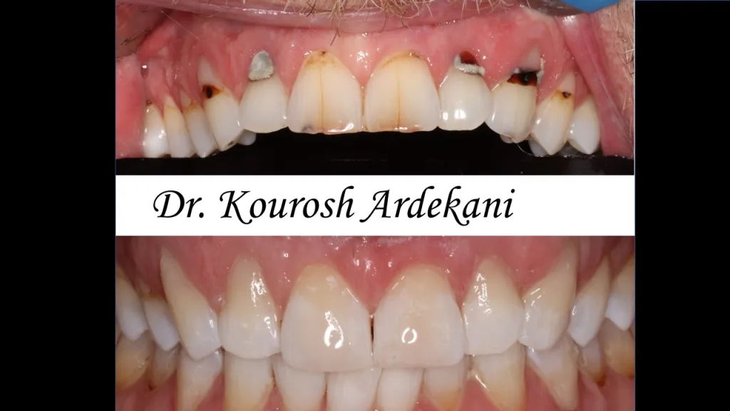 Front teeth of a patient