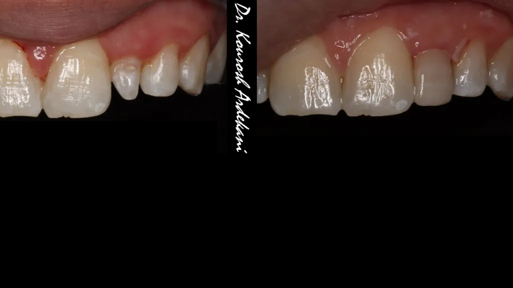 Front teeth of a patient