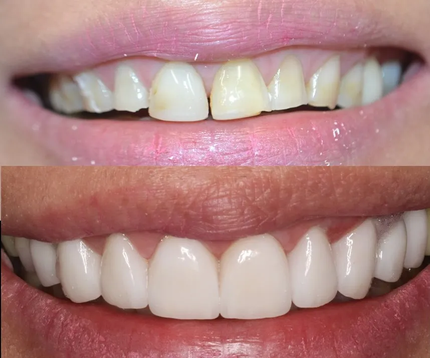 Front teeth of a patient