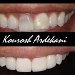 Front teeth of a patient