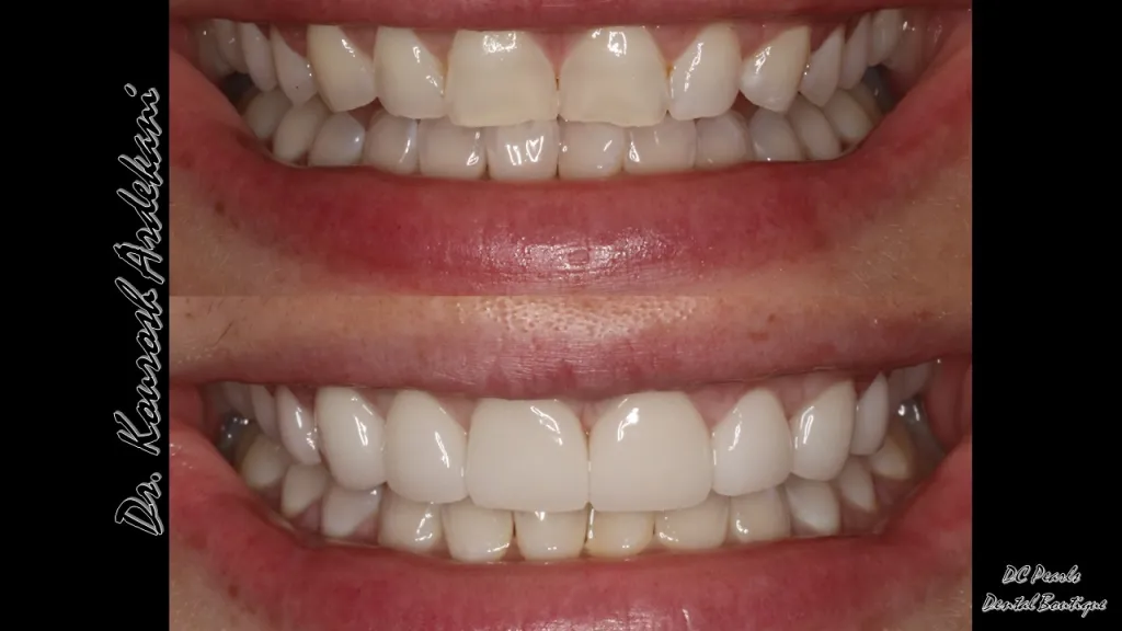 Front teeth of a patient