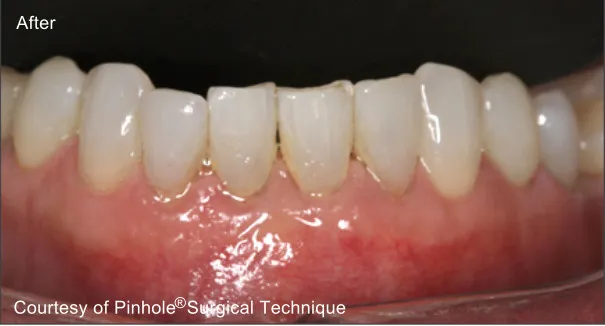Front teeth of a patient