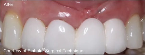 Front teeth of a patient
