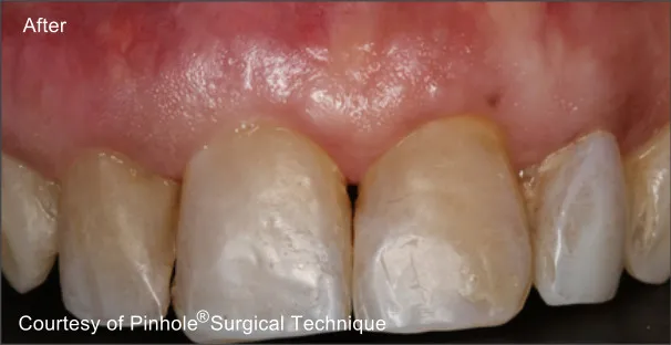 Front teeth of a patient