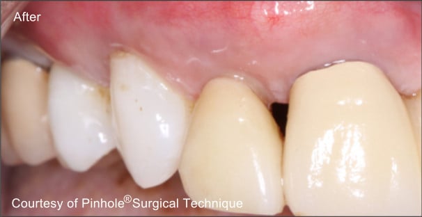 Front teeth of a patient