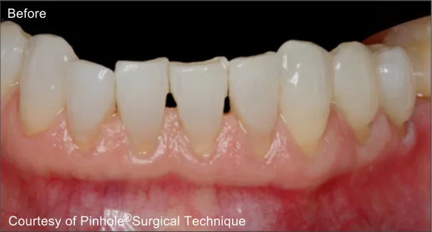 Front teeth of a patient