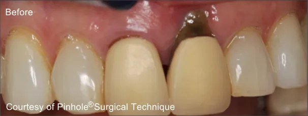Front teeth of a patient