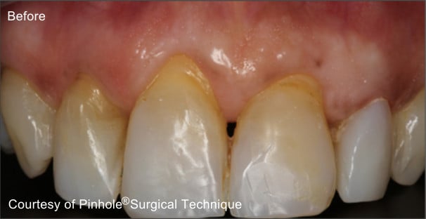 Front teeth of a patient