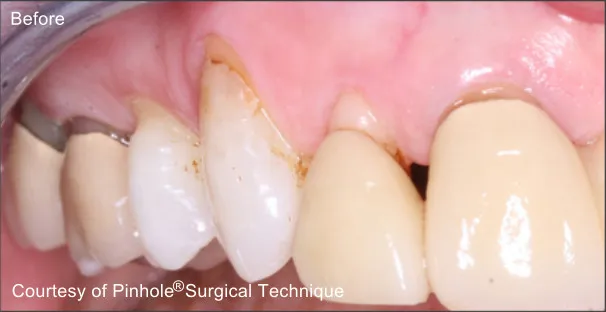 Front teeth of a patient